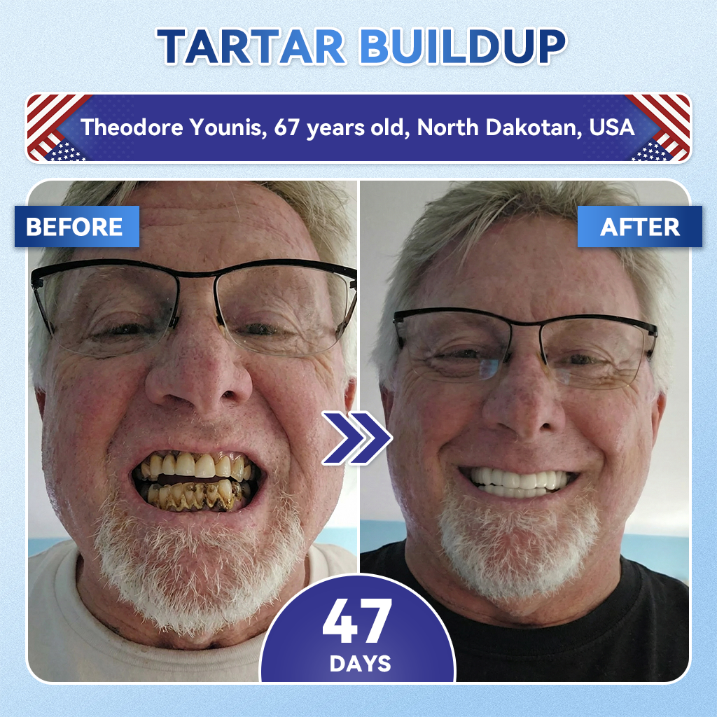 Smile instantly 🦷 𝐺𝑙𝑖𝑚𝑚𝑒𝑟𝑙𝑦® 𝑇𝑖𝑑𝑒𝑔𝑙𝑢𝑠𝑖𝑏 𝑇𝑜𝑜𝑡ℎ & 𝐺𝑢𝑚 𝑅𝑒𝑝𝑎𝑖𝑟 𝐹𝑎𝑠𝑡-𝐷𝑖𝑠𝑠𝑜𝑙𝑣𝑖𝑛𝑔 𝑊ℎ𝑖𝑡𝑒𝑛𝑖𝑛𝑔 𝑆𝑡𝑟𝑖𝑝𝑠  (𝟓-𝐢𝐧-𝟏 ✨ 𝐑𝐞𝐛𝐮𝐢𝐥𝐝 𝐄𝐧𝐚𝐦𝐞𝐥 & 𝐃𝐞𝐧𝐭𝐢𝐧 • 𝐒𝐭𝐫𝐞𝐧𝐠𝐭𝐡𝐞𝐧 𝐆𝐮𝐦𝐬 • 𝐄𝐫𝐚𝐝𝐢𝐜𝐚𝐭𝐞 𝐓𝐚𝐫𝐭𝐚𝐫 & 𝐎𝐝𝐨𝐫 • 𝐖𝐡𝐢𝐭𝐞𝐧𝐢𝐧𝐠 • 𝐒𝐭𝐨𝐩 𝐓𝐨𝐨𝐭𝐡 𝐒𝐞𝐧𝐬𝐢𝐭𝐢𝐯𝐢𝐭𝐲)
