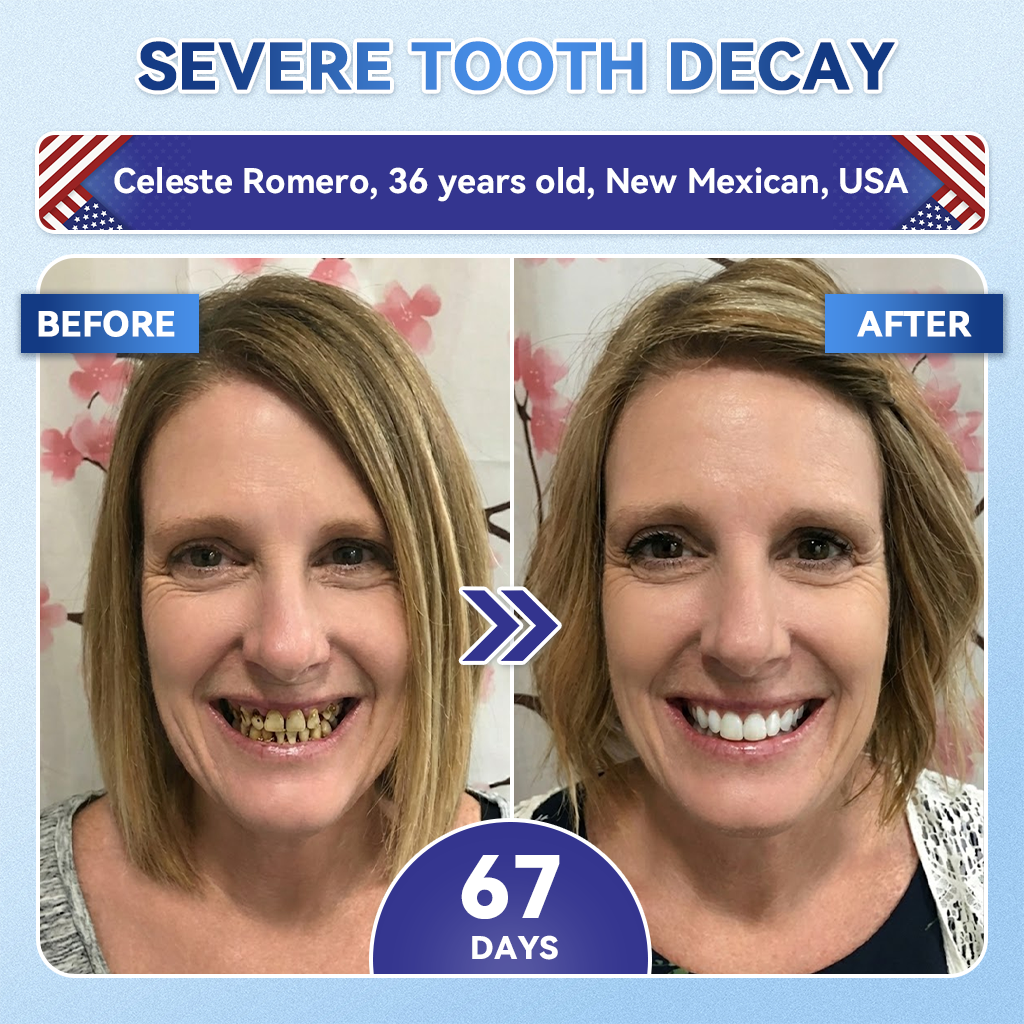 Glimmerly® 🦷 Tideglusib Fast‑Dissolving Tooth & Gum Repair Oral Strips 👀 (Supports tooth repair and helps relieve gum discomfort and other common oral concerns)