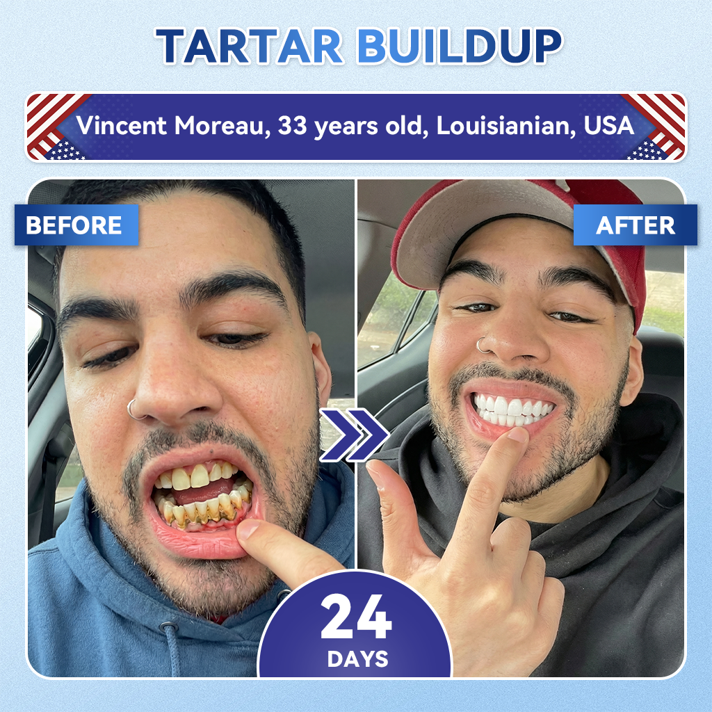 Glimmerly® 🦷 Tideglusib Fast‑Dissolving Tooth & Gum Repair Oral Strips 👀 (Supports tooth repair and helps relieve gum discomfort and other common oral concerns)
