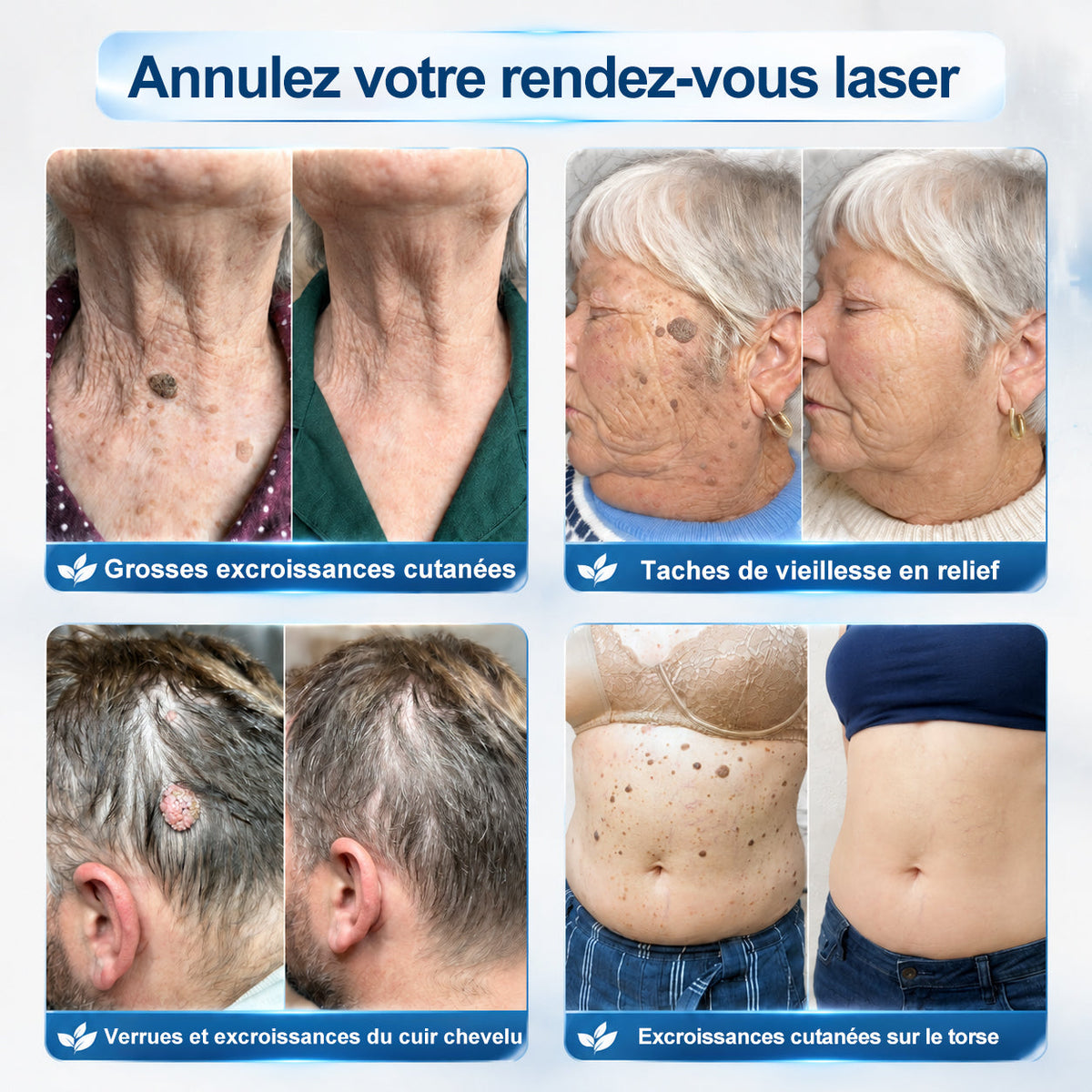 𝐏i𝐜𝐝o® 7 𝑱𝒐𝒖𝒓𝒔 𝑬𝒇𝒇𝒂𝒄𝒆𝒖𝒓 𝒅𝒆 𝒕𝒂𝒄𝒉𝒆𝒔 𝒆𝒕 𝒅’𝒆𝒙𝒄𝒓𝒐𝒊𝒔𝒔𝒂𝒏𝒄𝒆𝒔 𝒄𝒖𝒕𝒂𝒏é𝒆𝒔(Roll-on zéro douleur, zéro cicatrice)