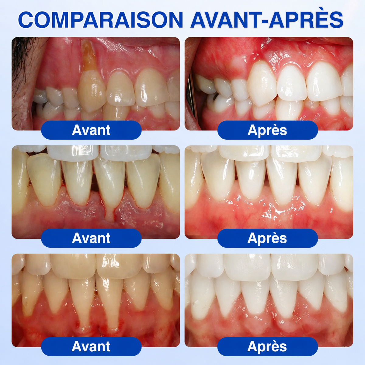 🇨🇦 𝑮𝒍𝒊𝒎𝒎𝒆𝒓𝒍𝒚®🦷 𝑮𝒖𝒎𝑹𝒆𝒗𝒊𝒗𝒆 𝑮𝒆𝒍 𝒅𝒆 𝑹é𝒑𝒂𝒓𝒂𝒕𝒊𝒐𝒏 𝑷𝒂𝒓𝒐𝒅𝒐𝒏𝒕𝒂𝒍𝒆🌻