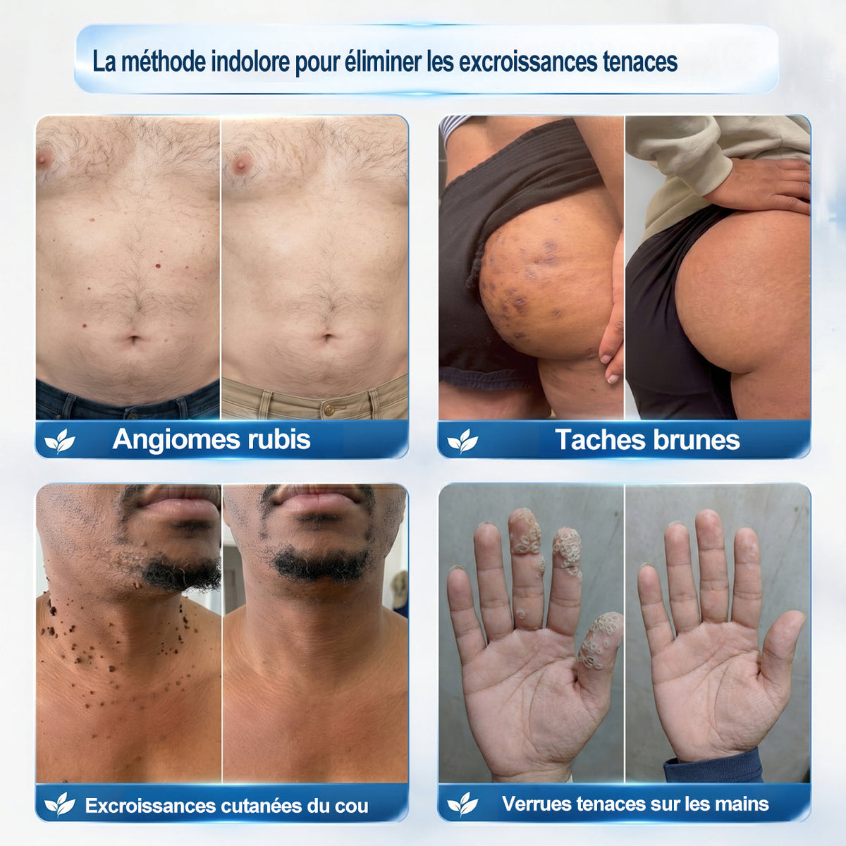 𝐏i𝐜𝐝o® 7 𝑱𝒐𝒖𝒓𝒔 𝑬𝒇𝒇𝒂𝒄𝒆𝒖𝒓 𝒅𝒆 𝒕𝒂𝒄𝒉𝒆𝒔 𝒆𝒕 𝒅’𝒆𝒙𝒄𝒓𝒐𝒊𝒔𝒔𝒂𝒏𝒄𝒆𝒔 𝒄𝒖𝒕𝒂𝒏é𝒆𝒔(Roll-on zéro douleur, zéro cicatrice)