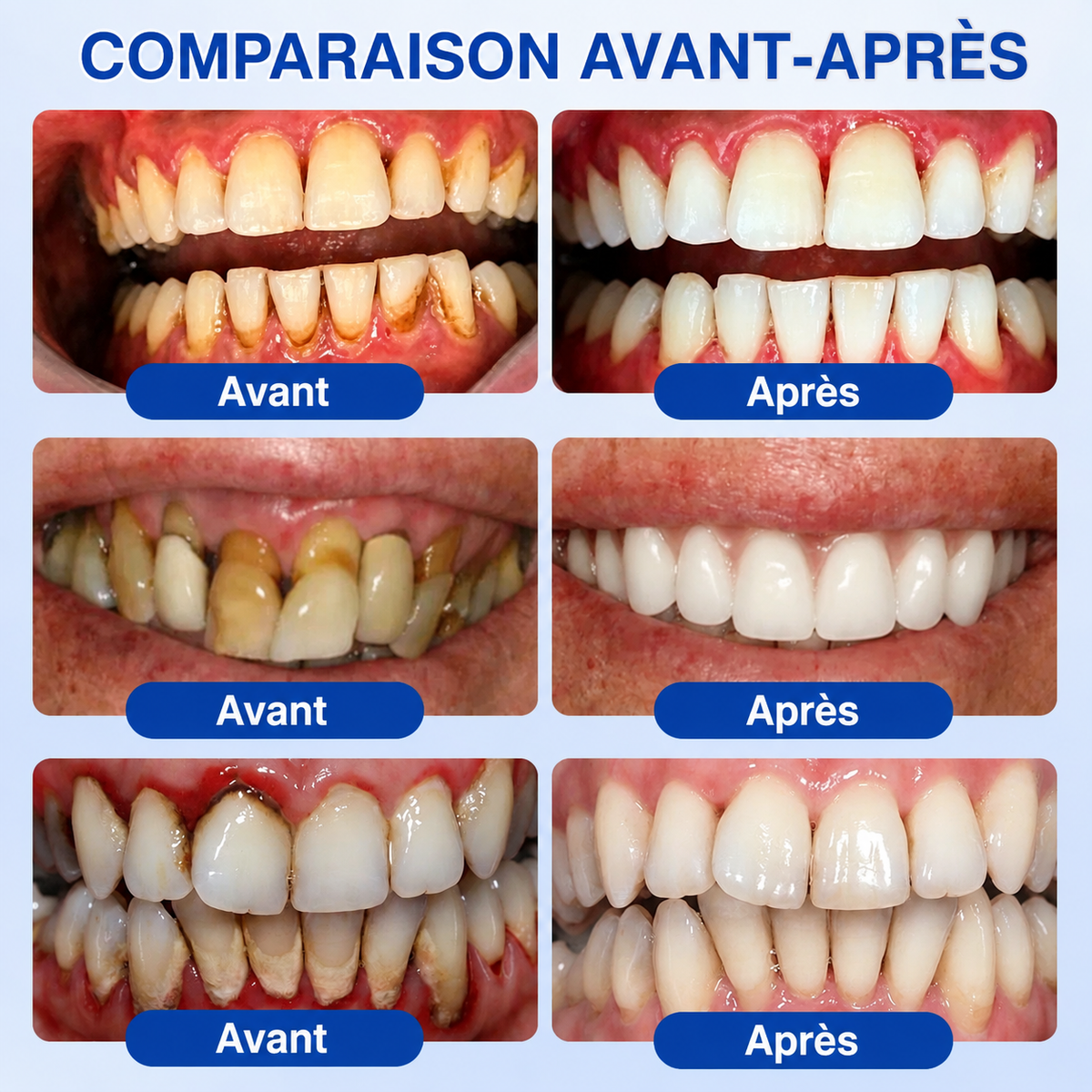 🇨🇦 𝑮𝒍𝒊𝒎𝒎𝒆𝒓𝒍𝒚®🦷 𝑮𝒖𝒎𝑹𝒆𝒗𝒊𝒗𝒆 𝑮𝒆𝒍 𝒅𝒆 𝑹é𝒑𝒂𝒓𝒂𝒕𝒊𝒐𝒏 𝑷𝒂𝒓𝒐𝒅𝒐𝒏𝒕𝒂𝒍𝒆🌻
